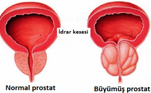 iyi-huylu-prostat-buyumesi-(bph)-tedavisinde-holep-ameliyati